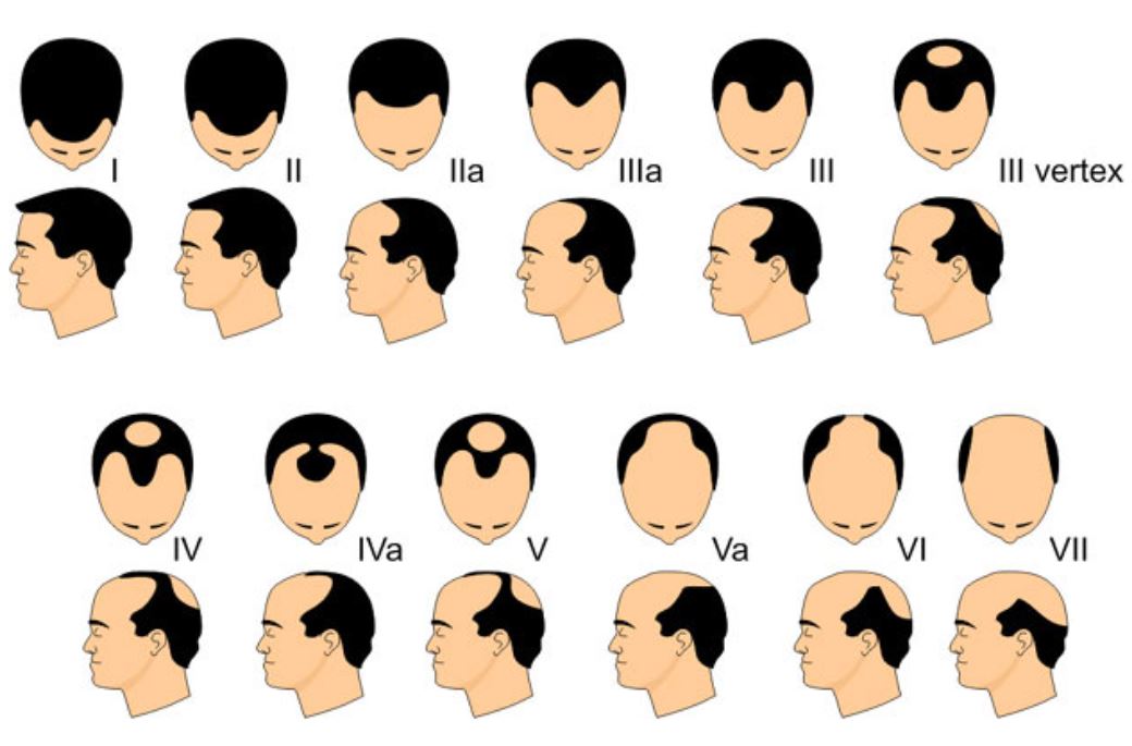 Alopecia Androgenética