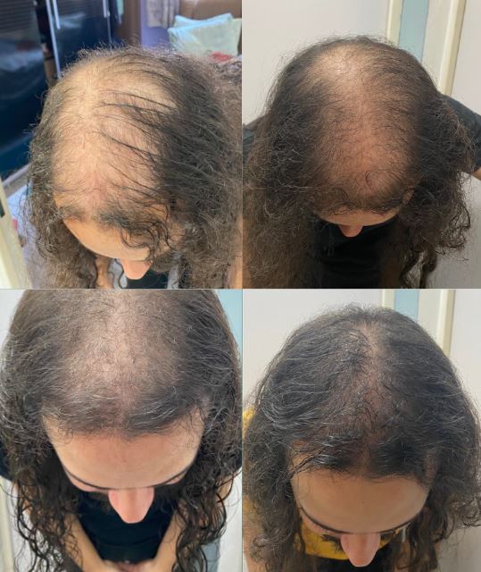 Alopecia Androgenética
