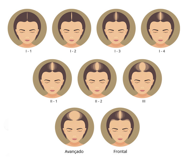 Alopecia Androgenética