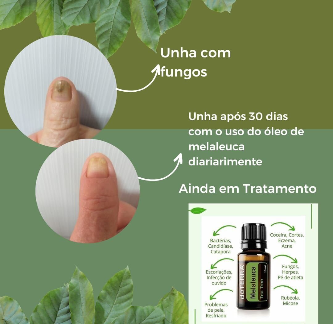 Onicomicose e Micose: Trate de Forma Natural